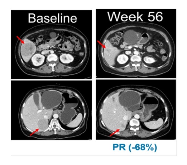 ▲ 임상 시작 전(Baseline, 좌측)과 벨바라페닙 투여 56주 후 흑색종 환자의 복부 CT사진.