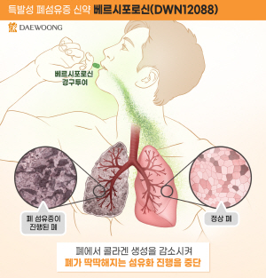 ▲ 대웅제약은 세계 최초 신약(First-in-class)으로 개발 중인 특발성 폐섬유증 후보물질 ‘베르시포로신(DWN12088)’이 유럽의약품청(European Medicines Agency, EMA)으로부터 희귀의약품으로 추가 지정받았다고 밝혔다.