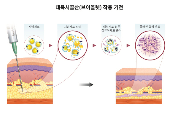 ▲ 브이올렛 등 지방파괴주사제의 주성분인 데옥시콜산의 팔뚝살 피하지방 분해 효과를 입증한 국내 연구결과가 처음으로 발표됐다.