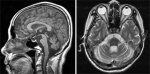 소뇌위축증 환자의 MRI 사진모습.