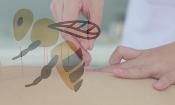 ▲ 봉침 시술 받고 사망한 환자의 응급처치를 도운 의사가 피소된 사건의 항소심 판결이 내려졌다. 재판부는 응급처치를 도운 의사의 배상책임을 인정하지 않고, 봉침 시술을 한 한의사의 배상만 명령했다.